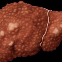 Viral hepatitis 'kills as many as Aids or TB' 