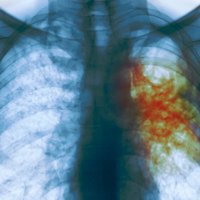 Superfast therapy cracks multidrug-resistant tuberculosis